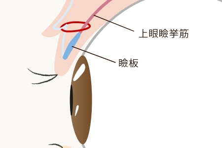 瞼板法