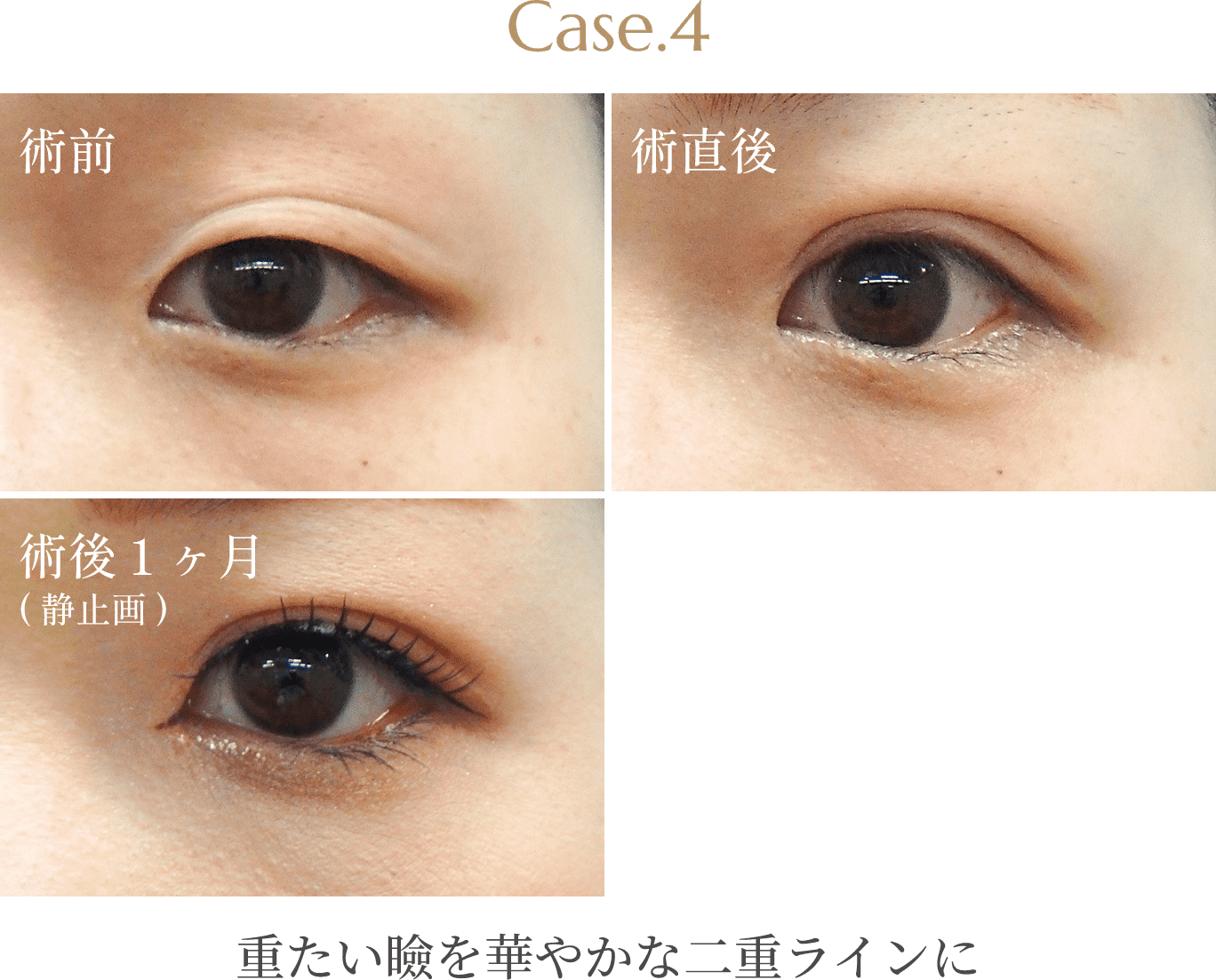 Case.4